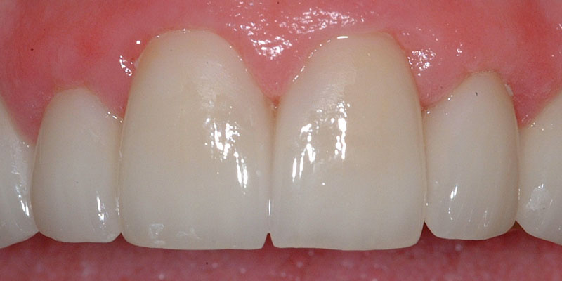 West Columbus Dental Implant Dentist After