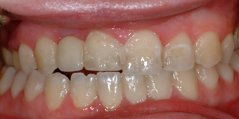 West Columbus Teeth Whitening Dentist Before