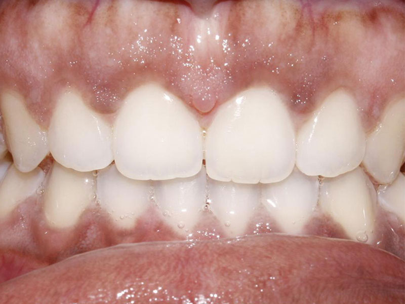 West Columbus Invisalign