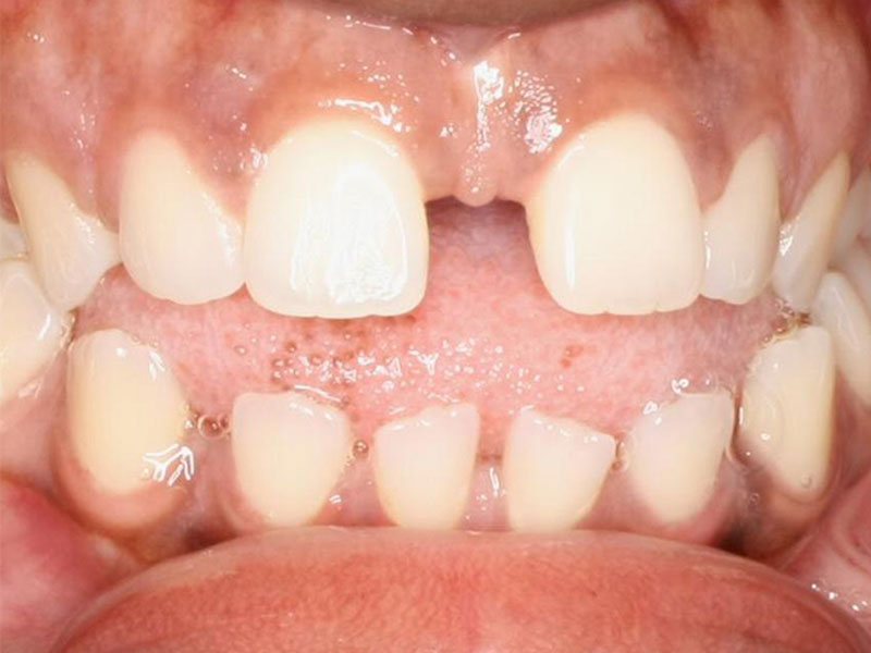 West Columbus Invisalign